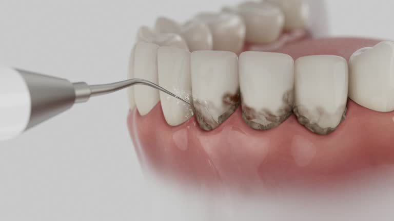 Trusted Wisdom Tooth Removal service in Balcones Heights, TX - Dentist Open Now